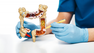 Profesional sanitario con guantes azules sostiene un modelo anatómico del intestino grueso, señalando una lesión en el colon, en el contexto de educación sobre el cáncer colorrectal.
