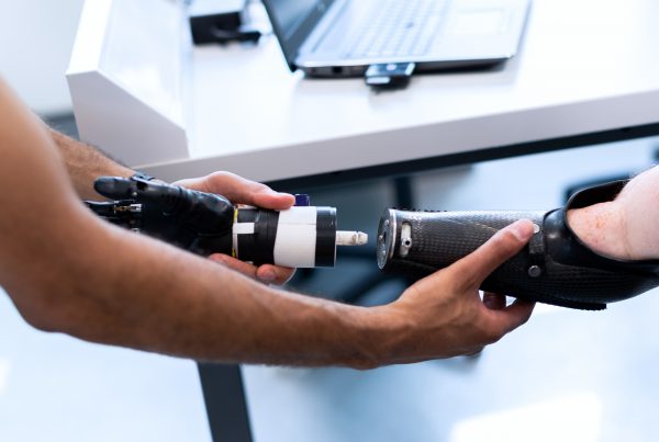 Mano protésica mioeléctrica siendo ensamblada a un encaje de brazo en una consulta técnica, relacionada con reinervación muscular tras amputación.